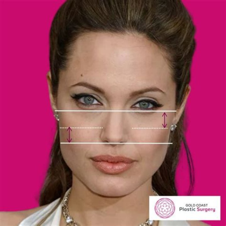 
Has Actress Isabell Hertel Done Botox? Beauty Secret For High Cheekbones 